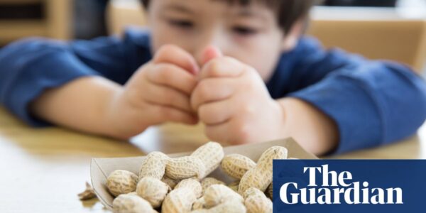 NHS trial uses daily doses of food allergens to tackle severe reactions