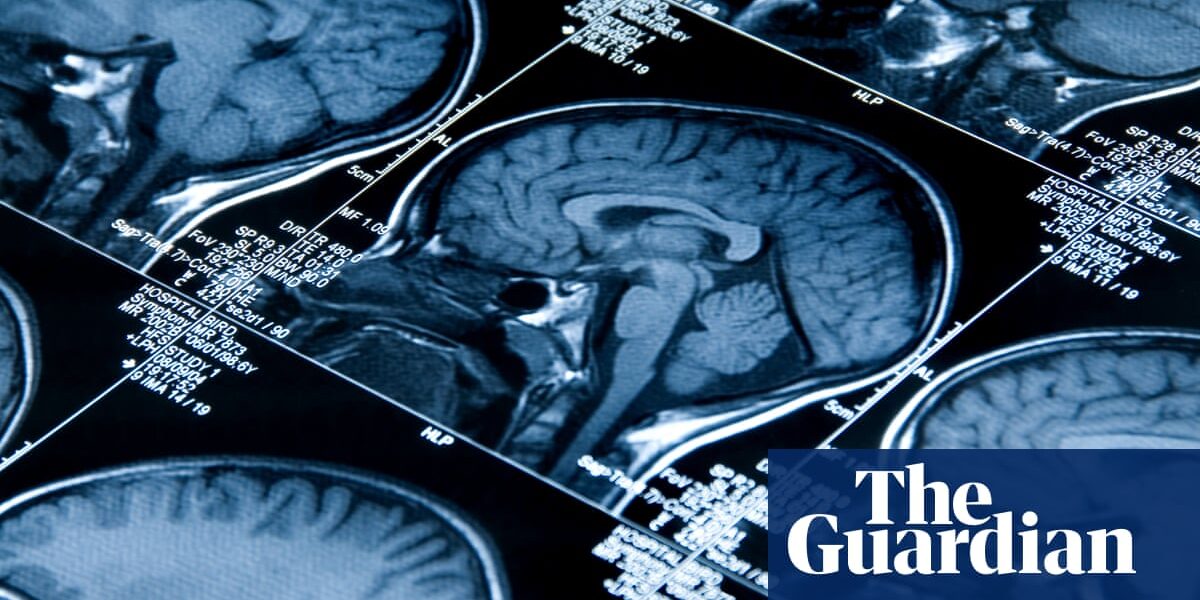 Ten-minute brain scan could detect dementia early, study suggests